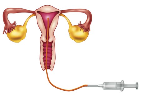 Como funciona a Inseminação